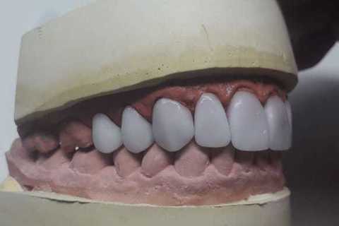 Reabilitação com Facetas em Porcelana Emax Fresadas