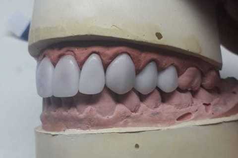 Reabilitação com Facetas em Porcelana Emax Fresadas