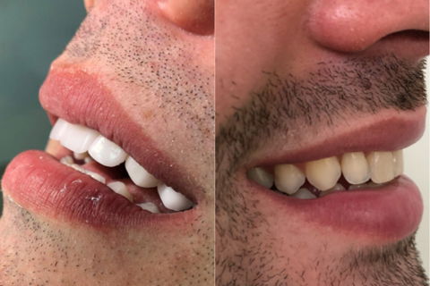 Perfil Antes e Depois