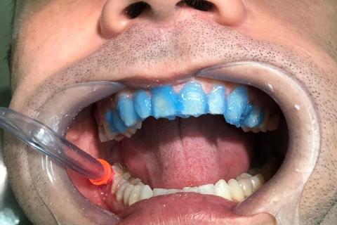 Aplicação do ácido fosforico e adesivo