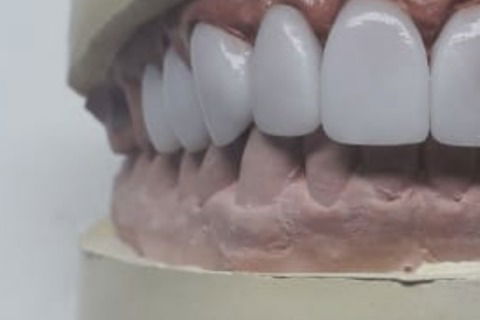 Reabilitação com Facetas em Porcelana Emax Fresadas