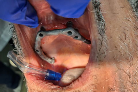 Prova da Estrutura metálica em boca