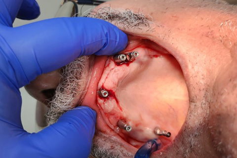 Instalação dos Implantes