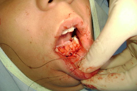 Sutura interrompida simples.