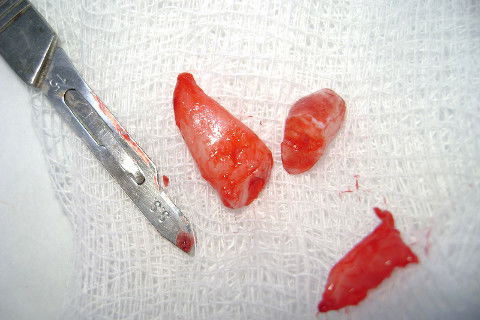 Porção radicular, porção coronal e capuz pericoronário.