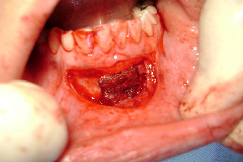 Preenchimento de toda cavidade com a esponja de colágeno.