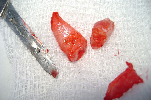 Interessante observar na porção coronal, a marca da odontossecção. Feita parcialmente preservando a integridade dos dentes vizinhos.