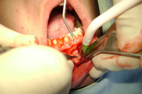 Ostectomia com broca esférica PM número 6. Bastante irrigação e cuidado.