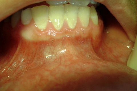 Aspecto inicial, foi preciso fazer uma profilaxia com jato de bicarbonato antes da cirurgia.