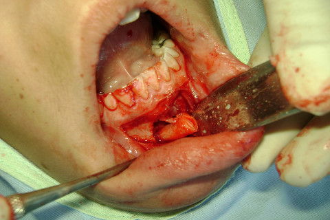 Remoção de Canino Incluso.