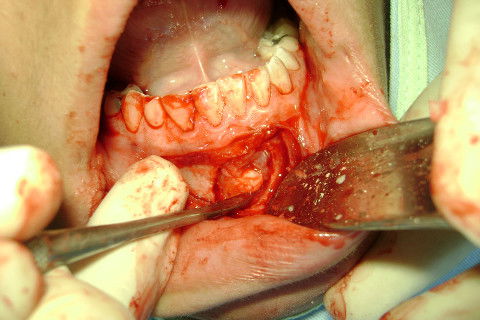 Elevação da porção radicular com o Molt 9.