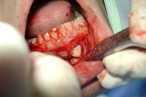 Odontossecção parcial da coroa com broca 703 PM.