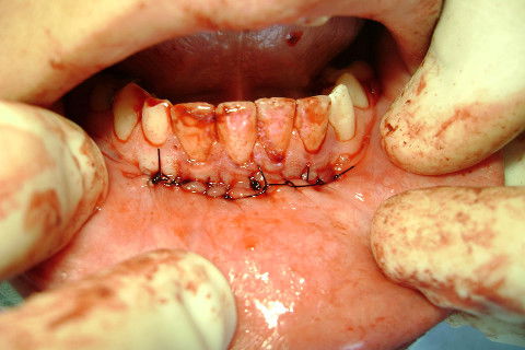 Resolvi fazer uma sutura continua festonada entre os espaços da sutura simples.