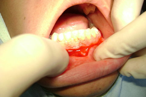 Remoção de Canino Incluso.