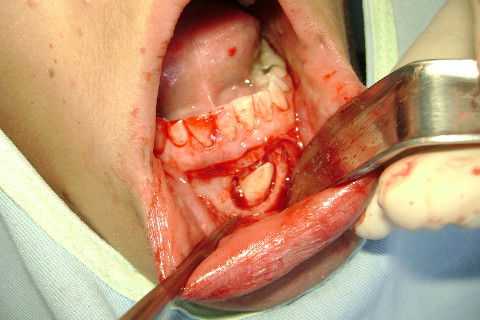 Ostectomia completa com exposição da coroa, suficiente para execução da odontossecção. Com uma alavanca Seldin Reta o elemento foi levemente 