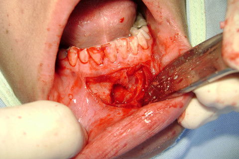 O restante de capuz pericoronário foi removido e a região irrigada com soro.