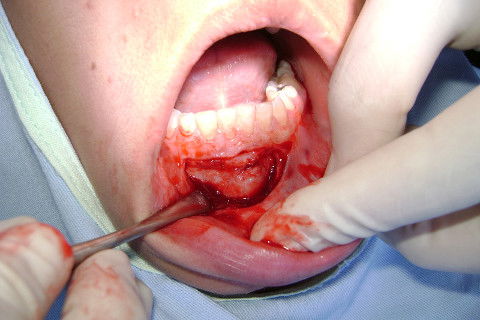 Incisão completa e inicio do descolamento com Molt 9.