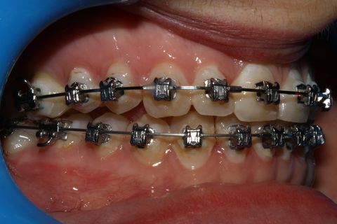 dois meses após, terceira troca de fios