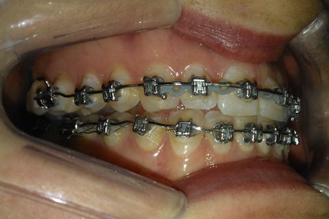 DOBRAS DE ACABAMENTO E ELÁSTICO CONTINUO PARA CONSOLIDAÇÃO DE ESPAÇOS.