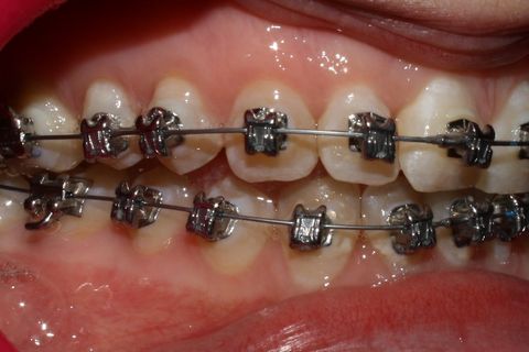 primeira troca de fios (10 semanas da colagem superior)