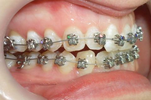 dia da colagem da arcada superior e 3 semanas da instalação do inferior