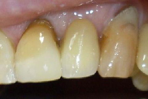 CIMENTAÇÃO DA COROA E RESTAURAÇÕES REALIZADAS