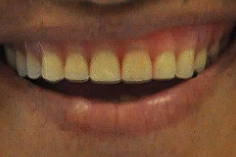 Aspecto clinico com Prótese Total Imediata