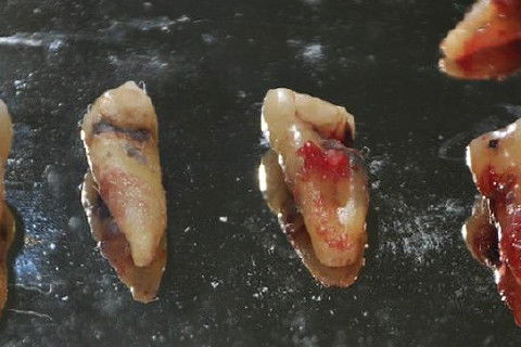 Elementos dentários removidos