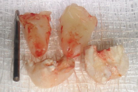 Exodontia do Dente 48 com Inclusão Mesio-Angular e Impactado no 47