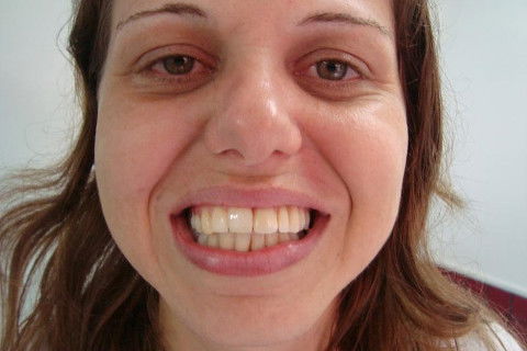 orto para centralizar ,implant + ceramica com gengiva artificial