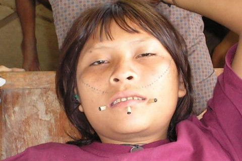 menina ianomami em trat dentario