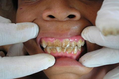 ação do fumo nos dentes das crianças indigenas