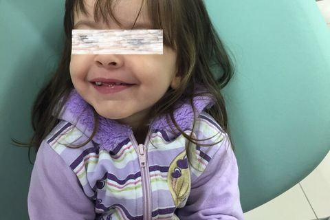 Perda Precoce de Dentes Decíduos; Intervenção Ortopédica Facial.