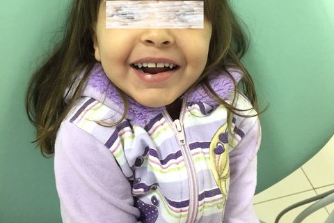 Perda Precoce de Dentes Decíduos; Intervenção Ortopédica Facial.