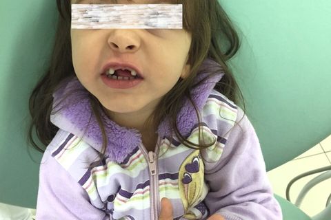 Perda Precoce de Dentes Decíduos; Intervenção Ortopédica Facial.
