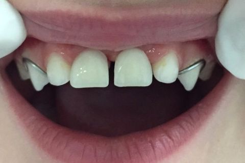 Perda Precoce de Dentes Decíduos; Intervenção Ortopédica Facial.