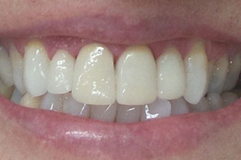 final - notamos o posicionamento ideal do elemento 22 sem que fosse feita a ortodontia. A paciente sente se satisfeita com o resultado, principalmente pela agilidade na resolução do caso que foi de 02 dias.