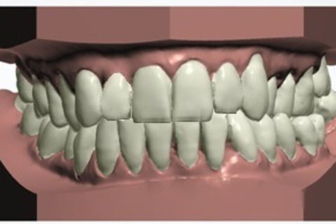 simulação do final do tratamento com alinhadores removíveis. Mesmo assim, a paciente não aceitou o tratamento com alinhadores ortodônticos.