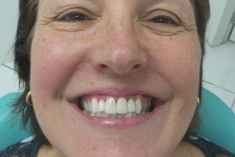 cimento utilizado allcem veneer - Dr. Bruno Jaeger