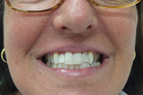 Mock up dos 4 incisivos superiores em resina composta. A paciente optou pelo tratamento com laminados cerâmicos.