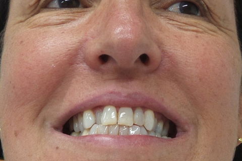 inicial frontal - notamos um manchamento por tetraciclina mascarado por facetas em resina composta e clareamento