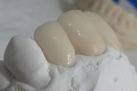 policromia feldspáticas - Dr. Bruno Jaeger