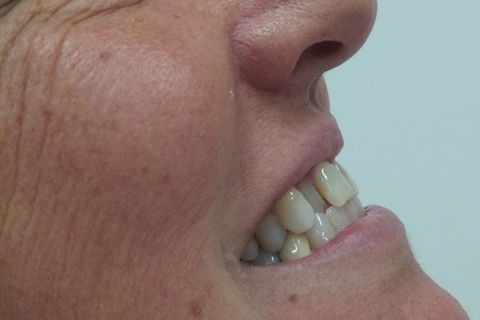 inicial lateral esquerda