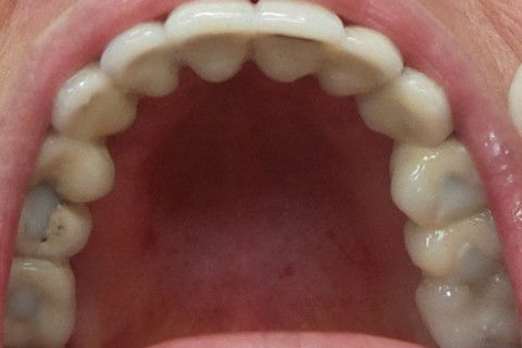 Vista Oclusal, parafusos selados com resina opaca