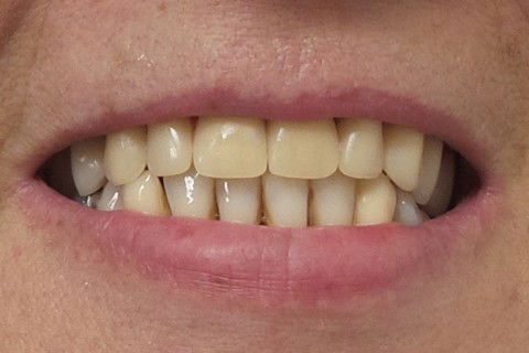 Primeira prova em cera para confecção de muralha em silicona. ( Facilita o posterior trabalho do ceramista)