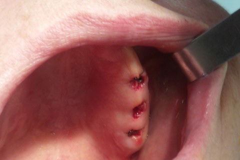 aspecto imediato cirurgia lado esquerdo (Cirurgia Flapless)