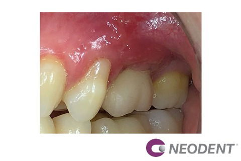 Reanatomização de Componente + Enxerto com Straumann® Mucoderm® para Solucionar Retração Gengival