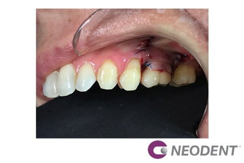 Reanatomização de Componente + Enxerto com Straumann® Mucoderm® para Solucionar Retração Gengival