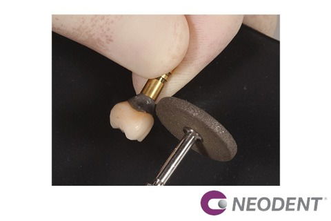 Reanatomização de Componente + Enxerto com Straumann® Mucoderm® para Solucionar Retração Gengival