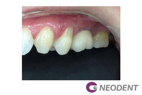 Reanatomização de Componente + Enxerto com Straumann® Mucoderm® para Solucionar Retração Gengival